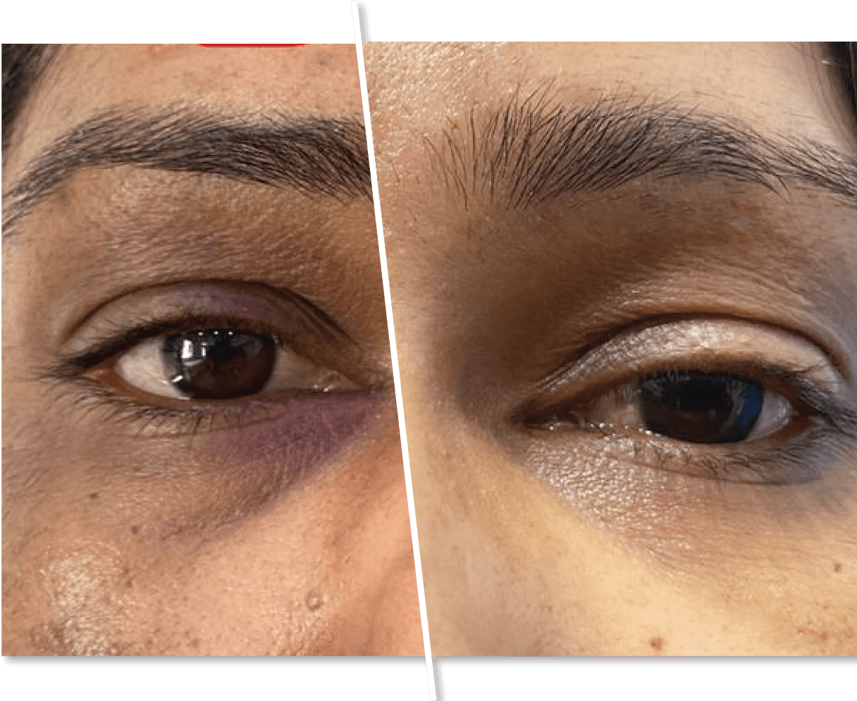 Under Eye Dark Circles Before and After